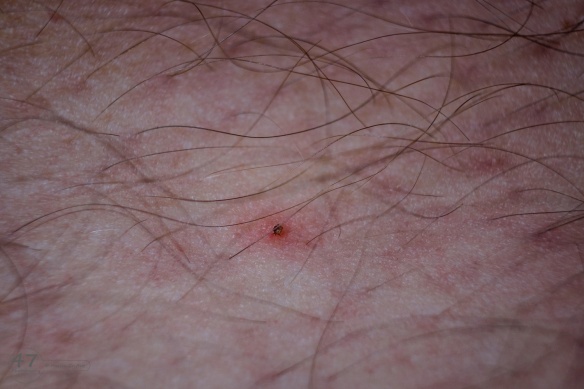 Image showing a tick attached to my leg